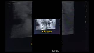 Neck Abscess Ultrasound Imaging Boyunda Abse Ultrason Görüntüsü
