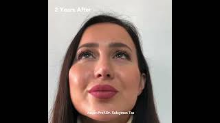 Rhinoplasty For Thick Skinned Patients | Dr. TAS