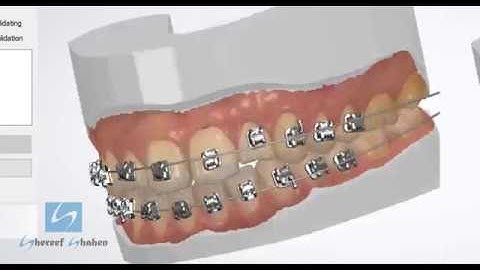 Digital indirect bonding 3shape (Workflow by Shereef Shahen)