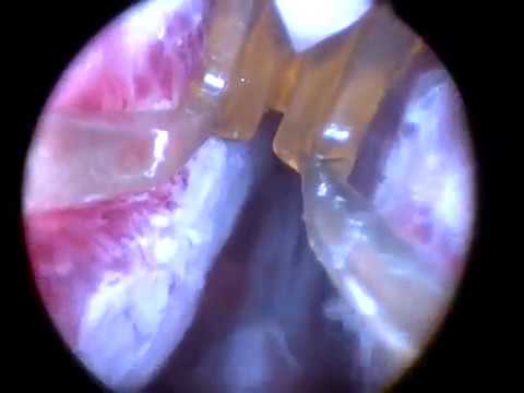 terapia termal rezum para próstata terapia termal rezum para próstata