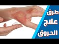 طرق علاج الحروق علاج درجات الحروق Burns الحلقه 1 من كورس OTC كورس التدريب الصيدلى 