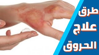 طرق علاج الحروق | علاج درجات الحروق | burns | الحلقه 1 من كورس OTC | كورس التدريب الصيدلى