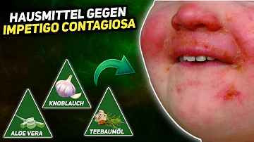 Was kann man gegen Impetigo machen?