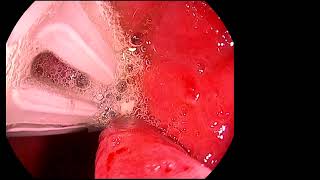 FLORIDA LIVE ENDOSCOPY (AUGUST 22-24, 2024) NEW TECHNOLOGY VIDEO