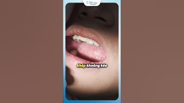 Vì Sao Phải Thay Chun Đơn Và Chun Chuỗi Khi Niềng Răng | Bác Sĩ Yên