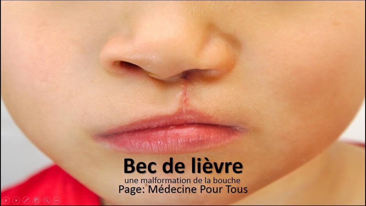Bec de lièvre - une malformation de la bouche - - YouTube