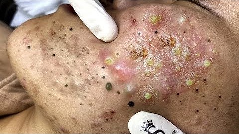 Most Satisfying Pimple Popping Compilation!" 