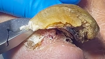 Thick Onychomycosis Becomes Curved, Carefully Remove【Pedicure Master Lin Jun】