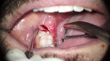 Extraction Without Forceps (E.W.F.) - Dr. Fabio Cozzolino | Zerodonto