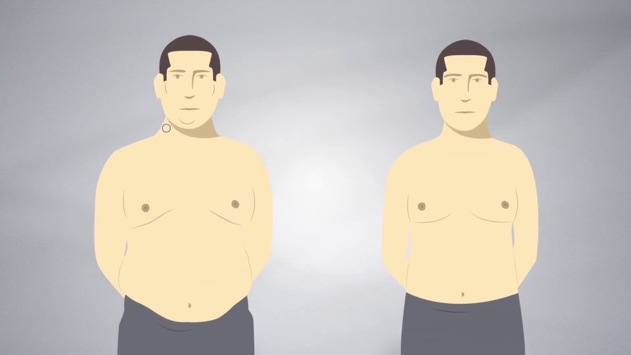 Gastrický bypass (Omega Loop) YouTube