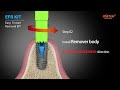 Osstem implant  efr kit easy fixture removal kit