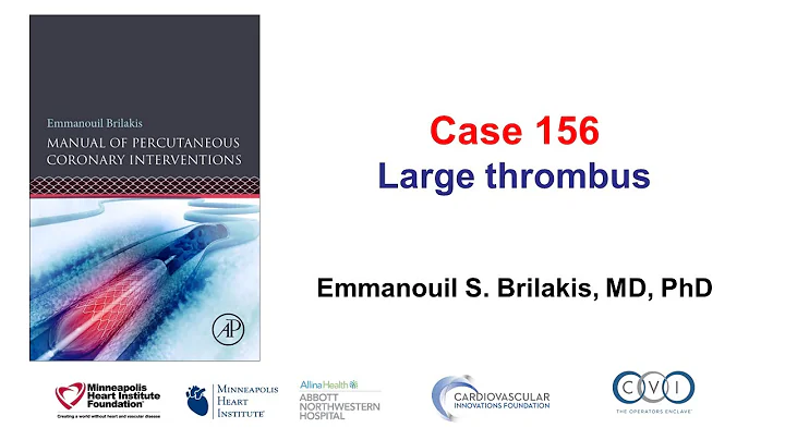 Case 156: Manual of PCI - Large thrombus