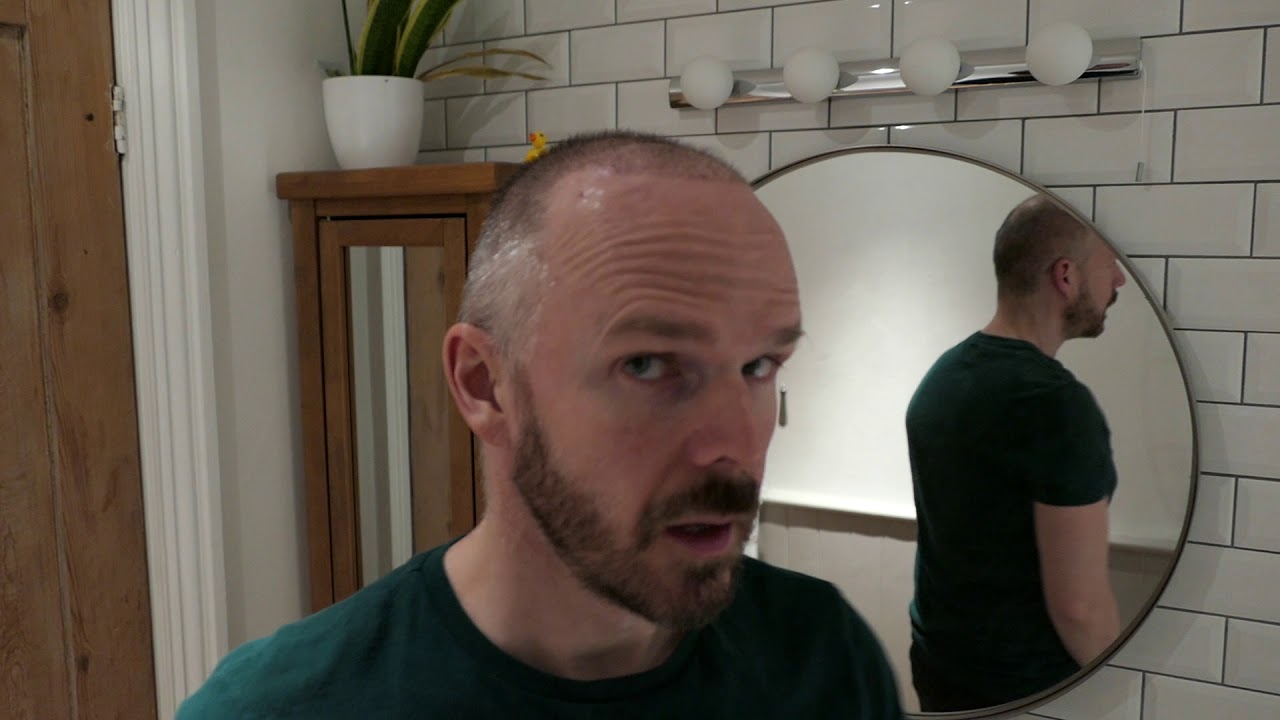 hairtransplant