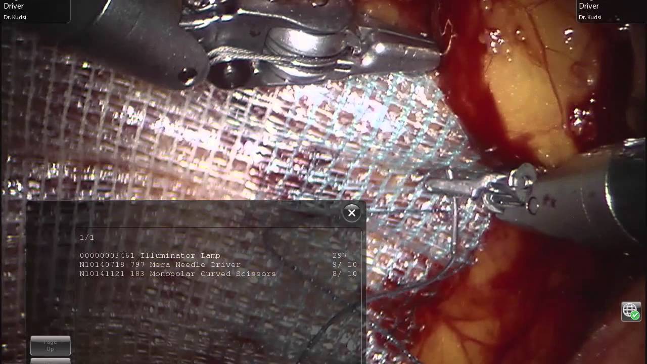 video phone beyonce mp3 TAPP -- Robotic Inguinal / Femoral Hernia Repair with mesh (Progrip)