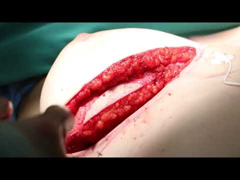 Houston, TX | Implant under a DIEP Flap for Breast Reconstruction | Chevray Plastic Surgery