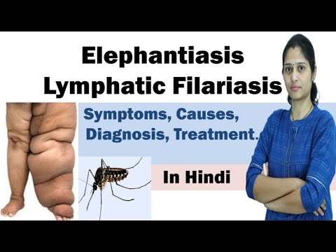 एलीफैंटियासिस | फाइलेरिया | लक्षण, कारण, निदान, उपचार, रोकथाम | हिंदी में
