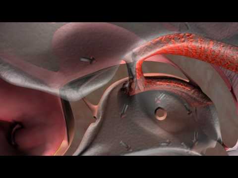 Video: Cerebrospinale Vloeistofabsorptieblok Op Het Hoekpunt Bij Chronische Hydrocephalus: Verstopte Arachnoïde Granulaties Of Verhoogde Veneuze Druk?