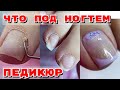 ОГРОМНЫЕ ПОДНОГТЕВЫЕ МОЗОЛИ 😧 Длиннющие ногти 💅 Педикюр френч