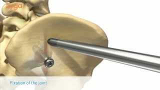 Why SImmetry Is More Effective Than Other SI Joint Fusions