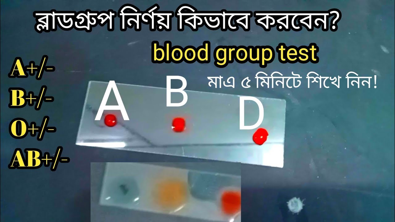 ব্লাড গ্রুপ নির্ণয় কিভাবে করে?A+ blood group A+/- B+/- O+/- AB+/- মাএ ...