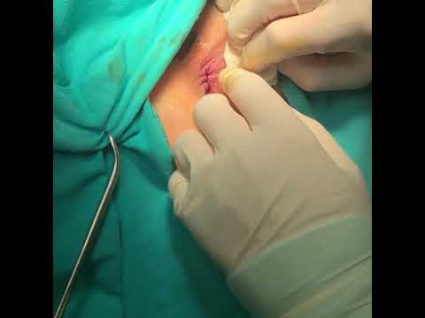 Video: Anal Fissur - Behandling, Kirurgi, Symptomer