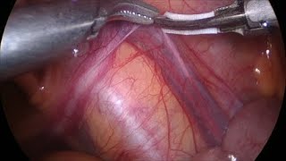 operaiunea video în varicoza