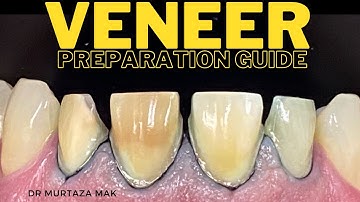 Veneer Preparation Guide