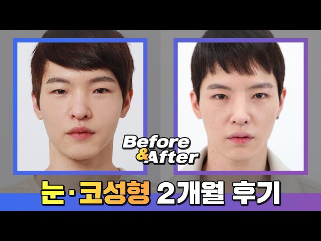 보정없는 남자 코성형후기_남자코성형 남자눈성형(속쌍꺼풀)2개월 비교후기