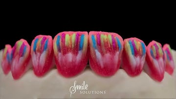 Porcelain Veneers multi-layering with Emax Press and Cream technique