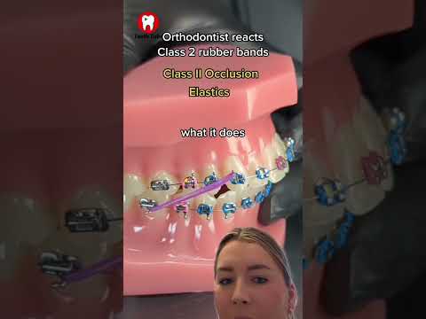 #orthodontist rubber bands
