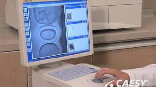 Crowns CADCAM Restoration Procedure