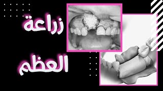أنواع زراعة العظم و التطعيم العظمي مع زراعة الأسنان
