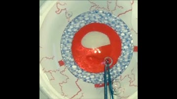 Capsulorhexis Technique with Dr, Lorenz Kuske, MD