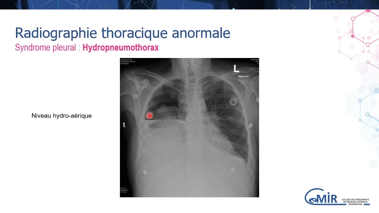 4 XX 1 Radiographie et scanner thoracique