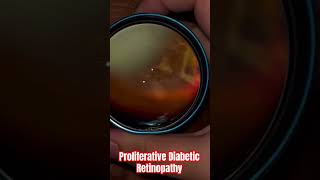 Proliferative Diabetic Retinopathy - PDR #diabetes #ytshorts #shorts #retina #eyes #sugar