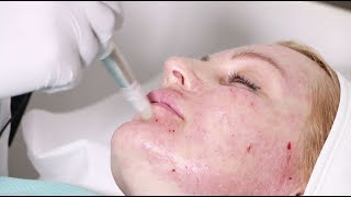 Hyaluronic acid mesotherapy and microneedling with vitamins