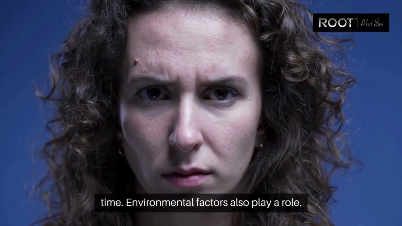 Botox for Gummy Smile Correction in Flower Mound & Dallas, TX: Quick Results