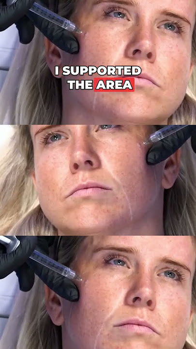 Impressive mid face transformation