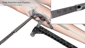 VA Proximal Tibial Plate Surgical Technique Animation