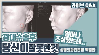 볼처짐, 불유합, 과교정은 여러분들이 만드는 거예요..광대수술후 잘못된 지식