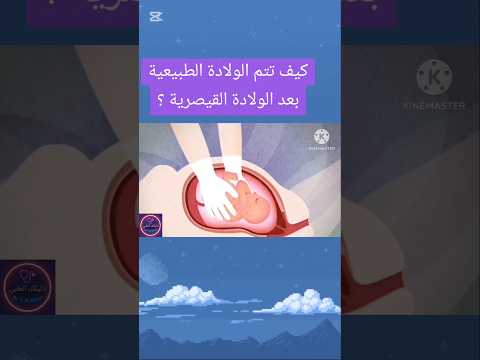 كيف تتم الولادة الطبيعية بعد الولادة القيصرية الولادة الطبيعية الولادة القيصرية صحة