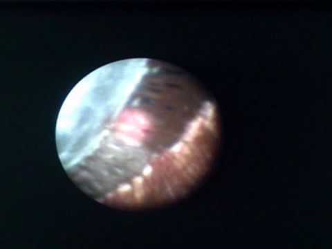Video: Metoder Til Behandling Af Glaukom