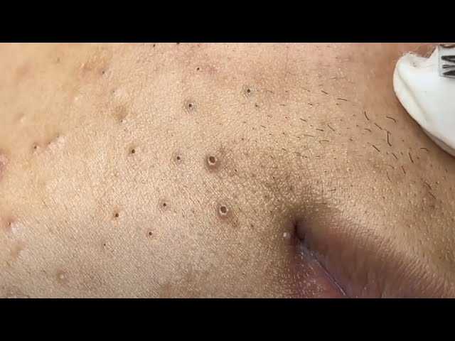 It so tempting to watch these juicy super blackheads