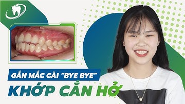Tạm Biệt Khớp Cắn Hở Nhờ Niềng Răng Mắc Cài Thông Minh