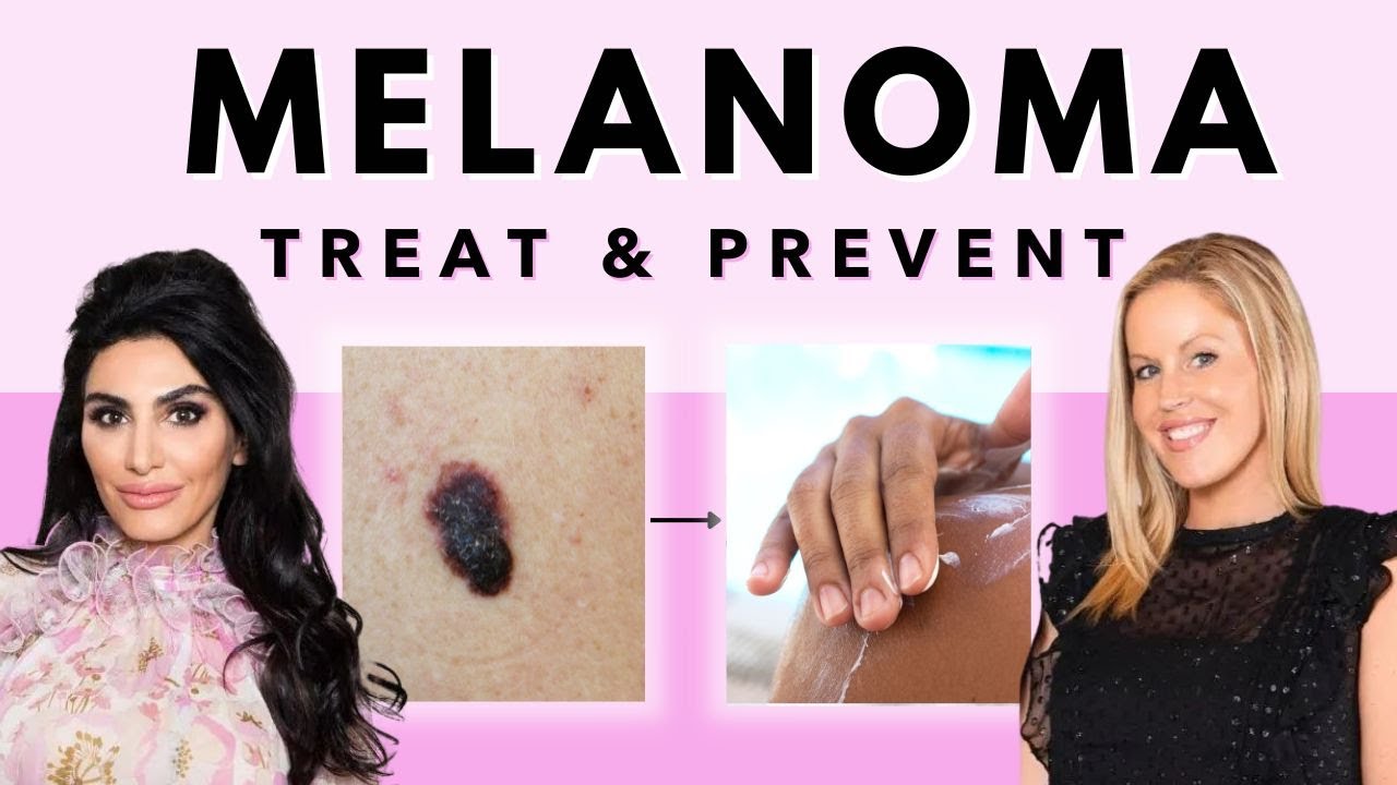 How to prevent & treat MELANOMA + Skin Protection TIPS | More Than A ...