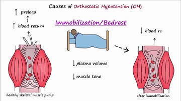 Orthostatic Hypotension (Described Concisely)