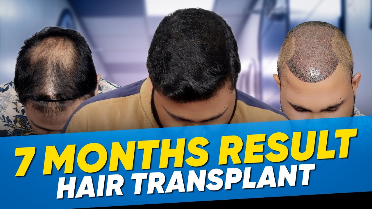 Hair Transplant in Colombia Best Results & Cost of Hair Transplant in Colombia YouTube