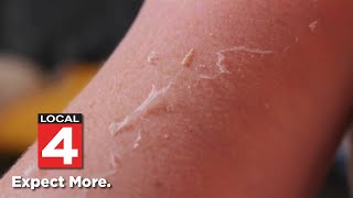 Avoid painful sunburns: Learn from Dr. Frank McGeorge’s mistake