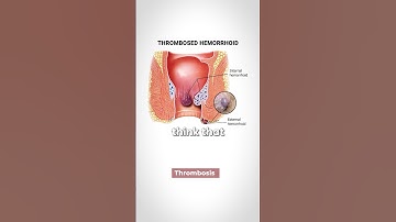 Hemorrhoids! What is the Cause?