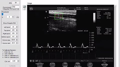 Flow Mediated Dilation - Ultrasound Video Analysis
